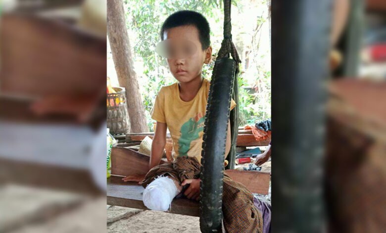 ပြီးခဲ့တဲ့ မေလ၂၇ရက်နေ့ လက်နက်ကြီးထိမှန်မူကြောင့် ခြေထောက်ဖြတ်လိုက်ရတဲ့ကလေးငယ်